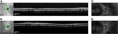 Structure and function of retinal ganglion cells in subjects with a history of repeated traumatic brain injury